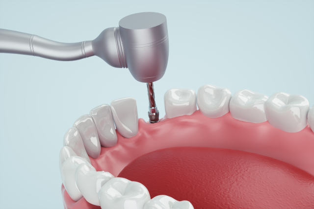 もちづき歯科医院 インプラント手術