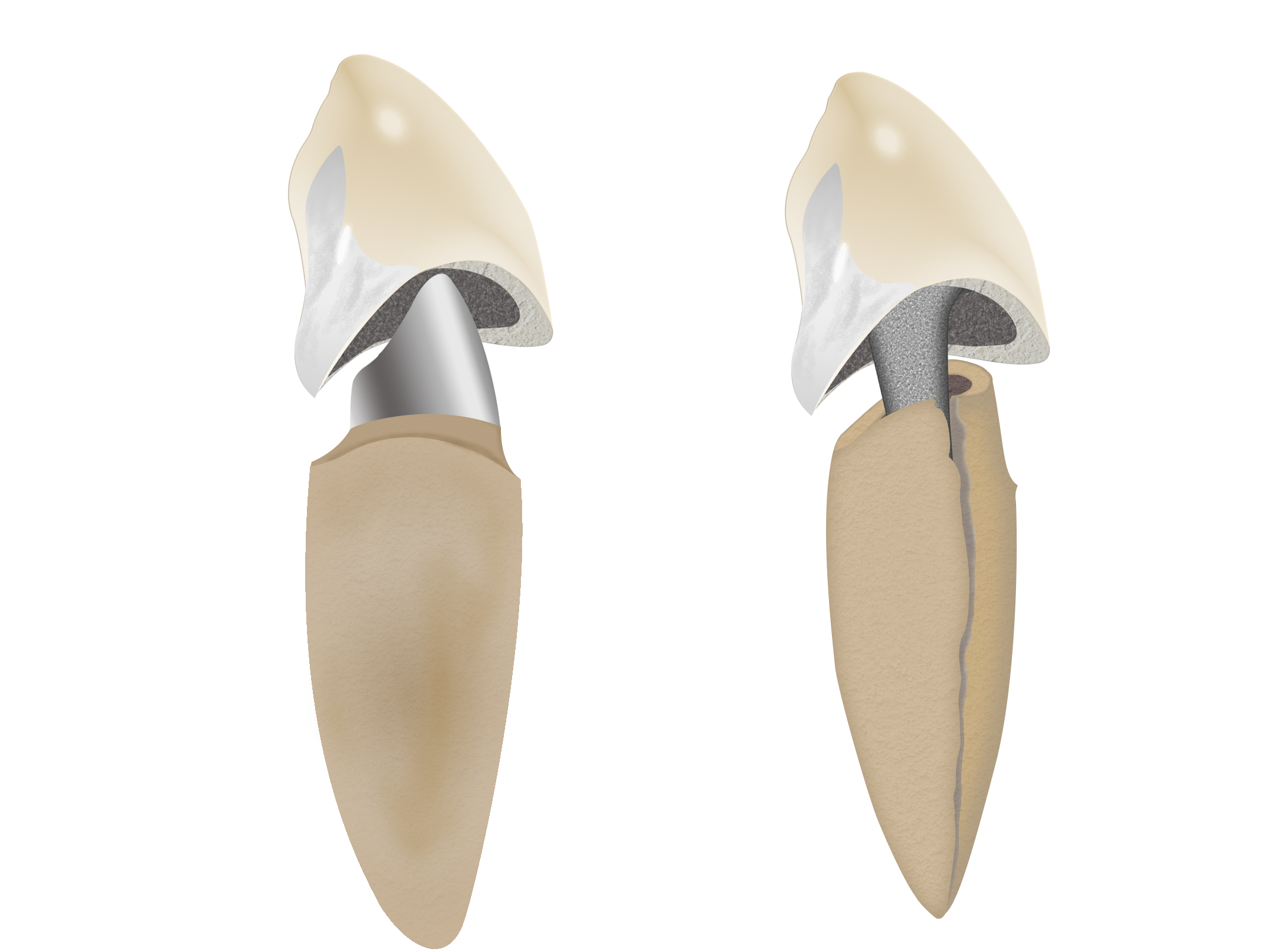 ファイバーコア